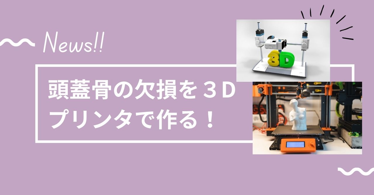 頭蓋骨の欠損を３Dプリンタで作る